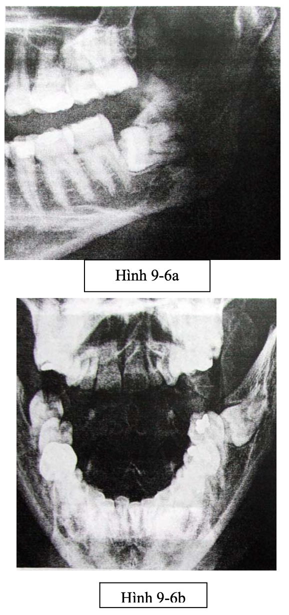 Tiểu phẫu răng khôn nghiêng gần 90 độ